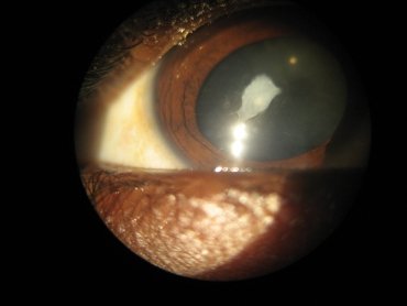 Corneal Abscess