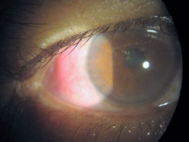 Vitreous opacities