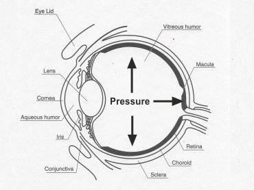Corneal Abscess