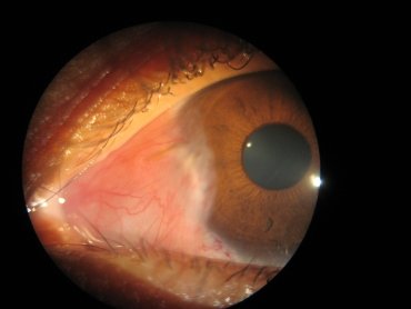 Corneal Abscess